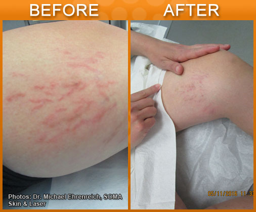 Sclerotherapy