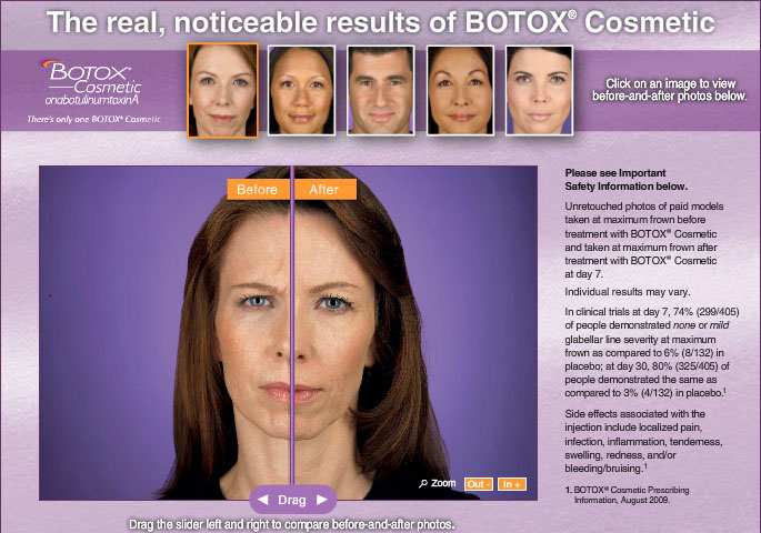 Botox Cosmetic
