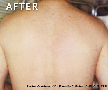 Laser Hair Removal