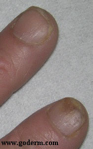Psoriatic nail changes