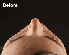 Before Voluma