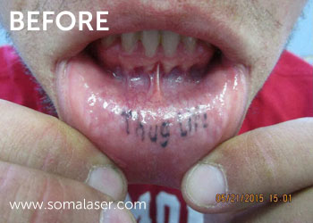 Laser Tattoo Removal