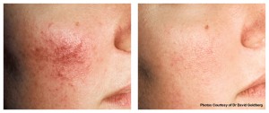 V-Beam Treatment V-Beam Treatment