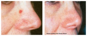 V-Beam Treatment V-Beam Treatment