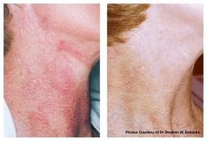 V-Beam Treatment V-Beam Treatment