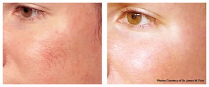 V-Beam Treatment V-Beam Treatment