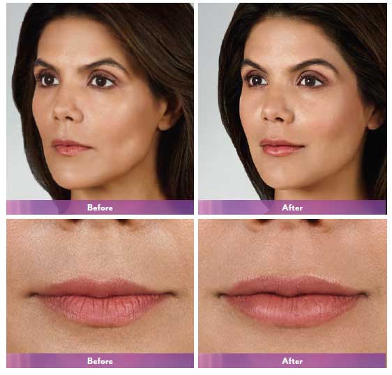 JUVÉDERM VOLBELLA® XC Before-and-After Photos (Michelle)