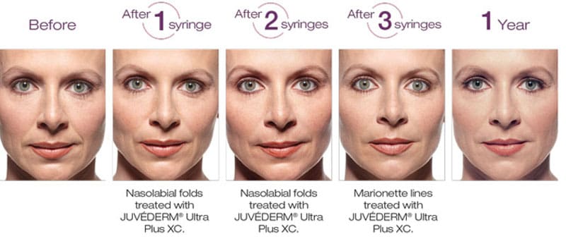 Juvederm