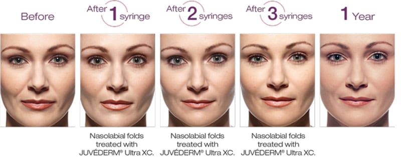 Juvederm