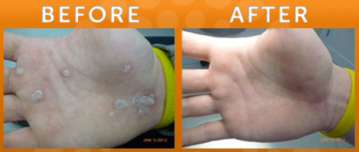 Laser Treatment for Warts in New Jersey SOMA Skin Laser