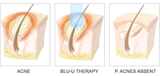 blu u treatment