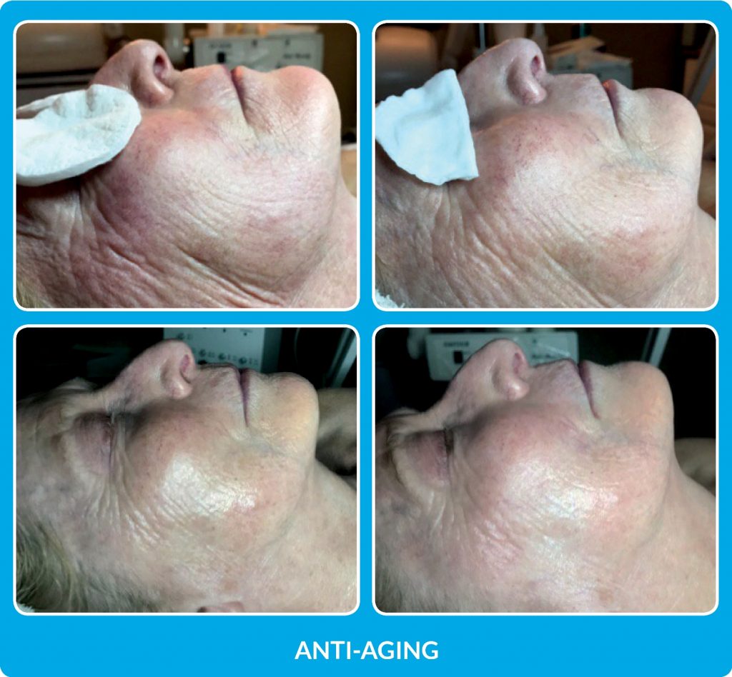 ProCell Before and After Anti-aging