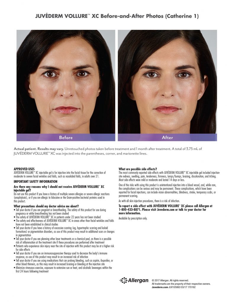 Juvederm Vollure Facial Filler