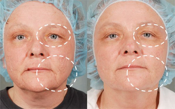 Fractional CO2 Laser Treatment in Millburn NJ SOMA Skin Laser