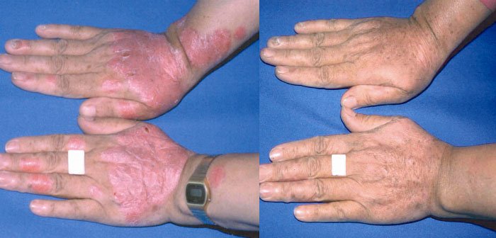 before and after laser treatment for psoriasis