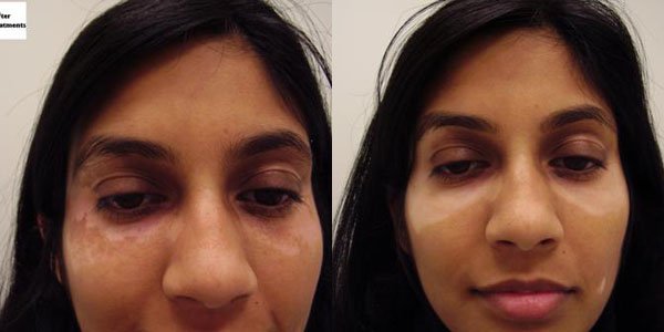 Pharos Excimer Laser for Vitiligo in New Jersey SOMA Skin Laser