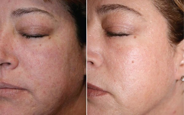 I Tried Fractional CO2 Laser Treatment, and I'm Amazed by the Results — See  Photos