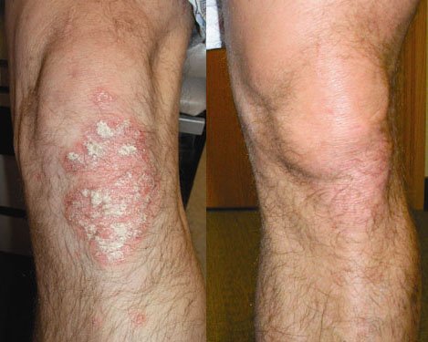 before and after laser treatment for psoriasis