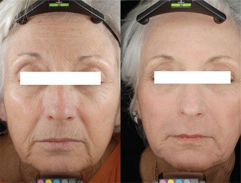 My Journey with CO2 Laser Resurfacing