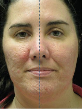 Fractional CO2 Laser Treatment in Millburn NJ