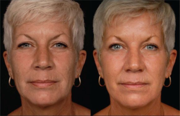 Fully Ablative CO2 Laser Resurfacing Treatment