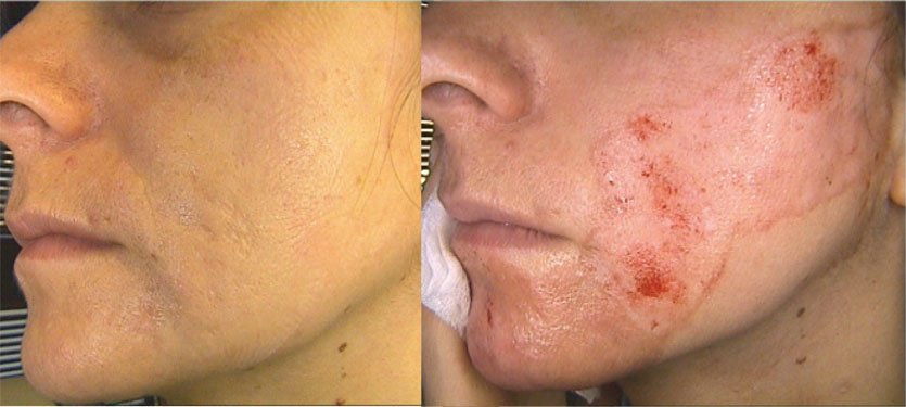 Fully Ablative CO2 Laser Resurfacing Treatment