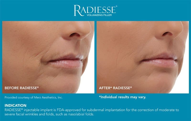 Radiesse before & after