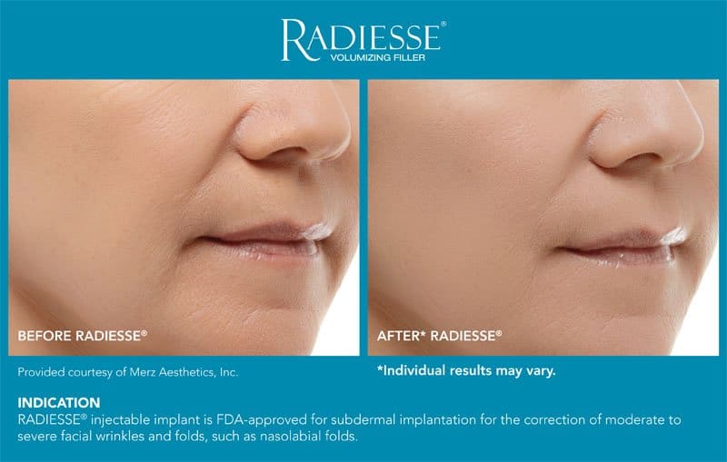 Radiesse before & after