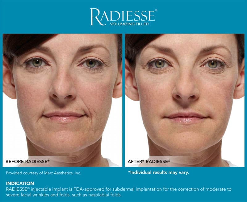 Radiesse before & after