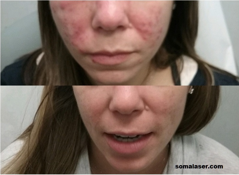 Acne Before & After 7 months of Isotretinoin