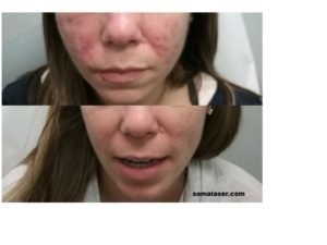 Acne Before & After 7 months of Isotretinoin