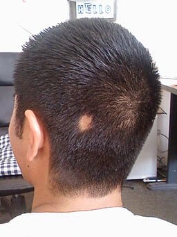 Methotrexate for Alopecia Areata