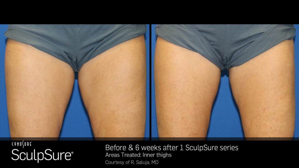 SculpSure Thighs