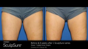 SculpSure Thighs