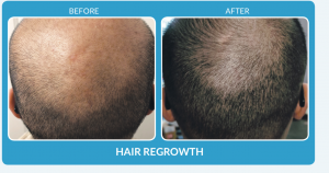 Hair Regrwoth with ProCell Before & After