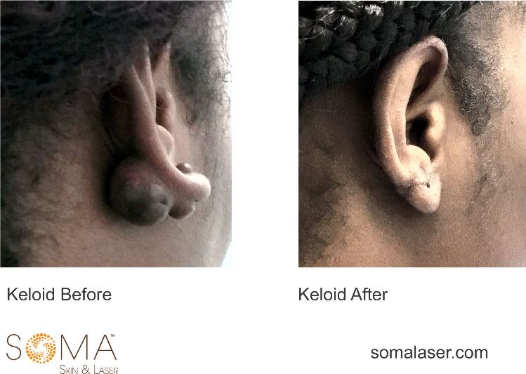 keloids on ears