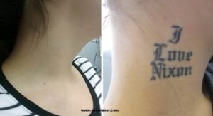 Laser Tattoo Removal Before and After