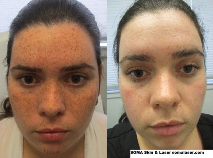 Revlite Laser For Freckles And Brown Spots In Nj Soma Skin And Laser 