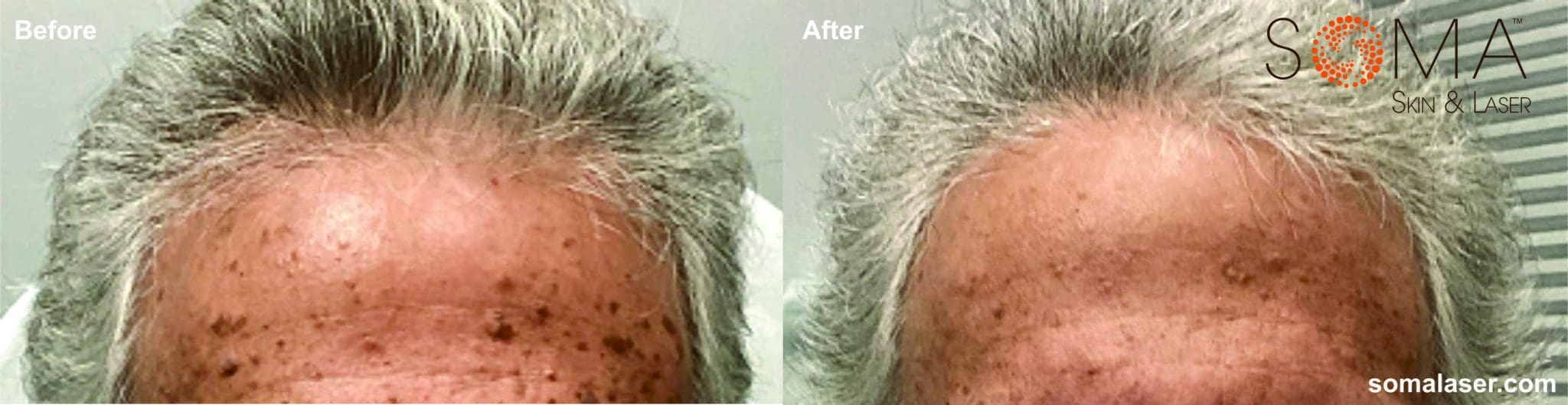 SK before after electrodessicaiton Somalaser