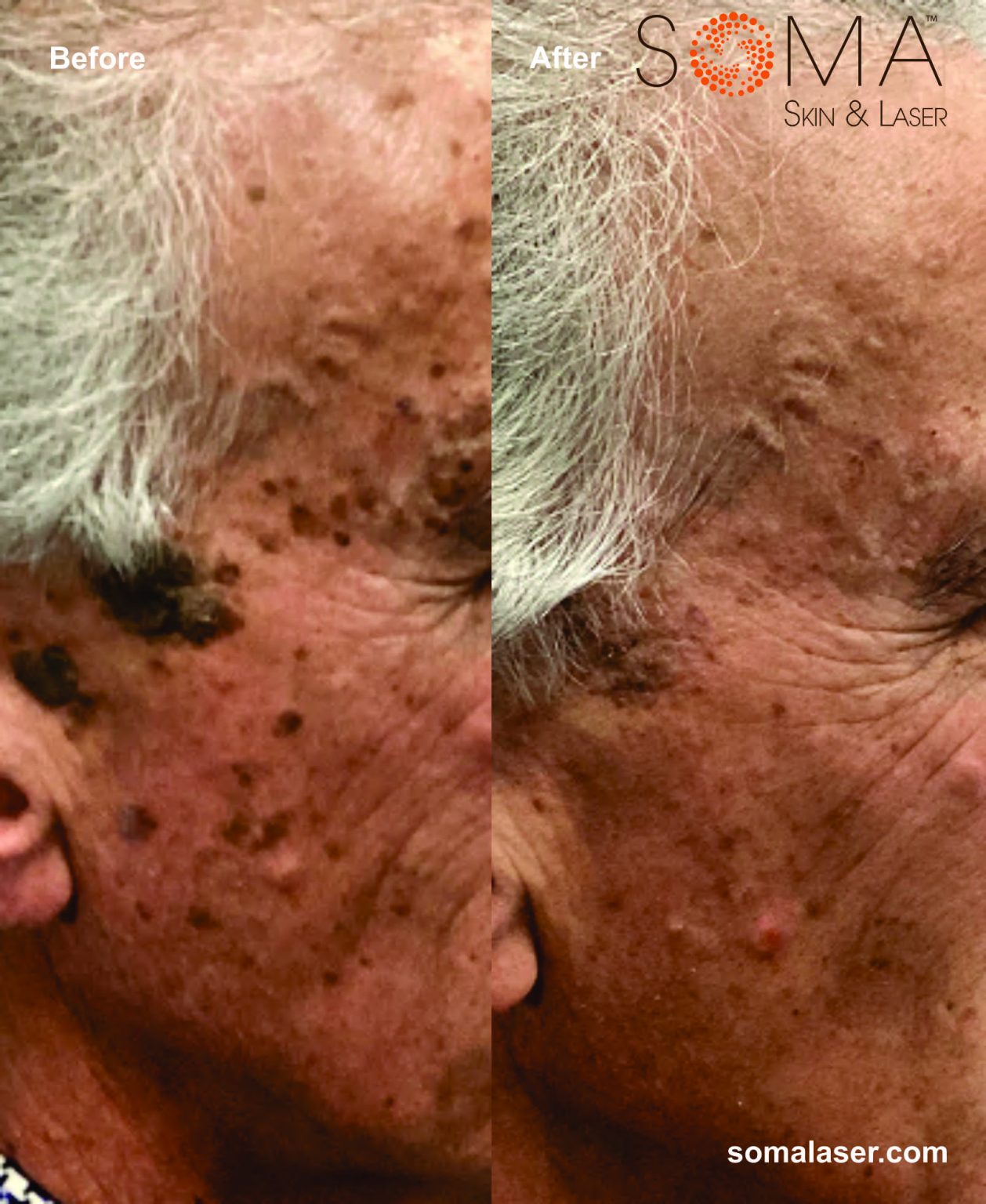 Electrodessication for Skin Lesions Somalaser