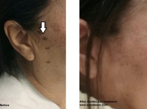 keratosis seborrheic removal laser skin sk1 jersey treatment soma gentlelase before after