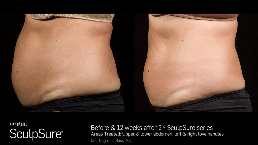 SculpSure Abdomen