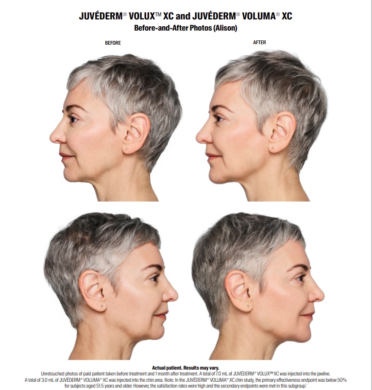 Juvederm Volux jawline injection in New Jersey