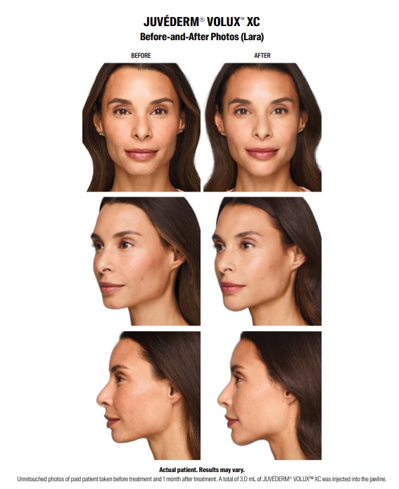 Juvederm Volux jawline injections in New Jersey