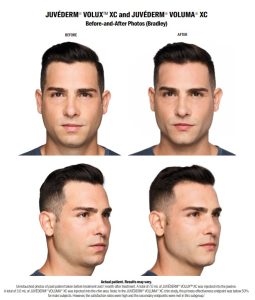 Volux for men. Male jawline injections in New Jersey