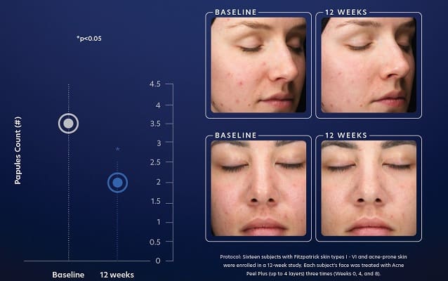 Acne Peel before & after