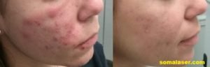 Acne before and after 8 months if isotretinoin