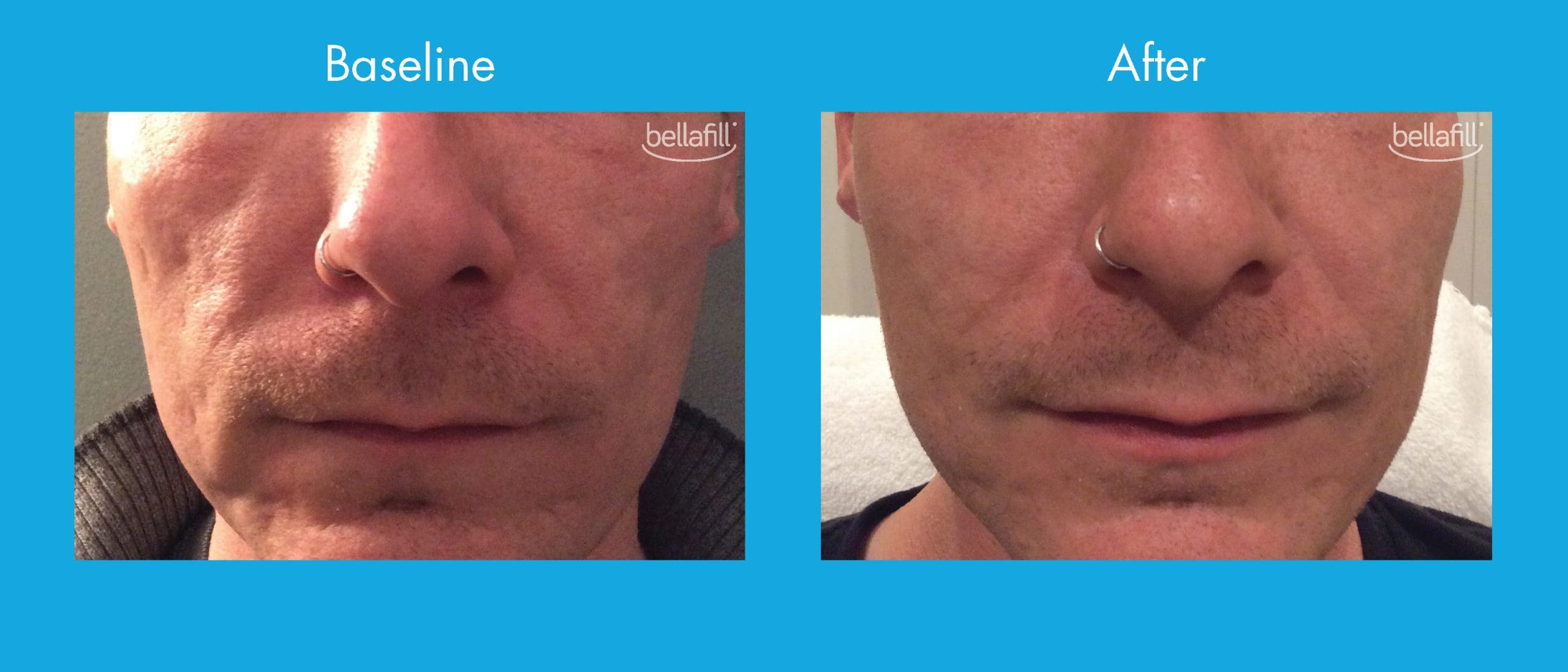 Bellafill Filler For Acne Scarring