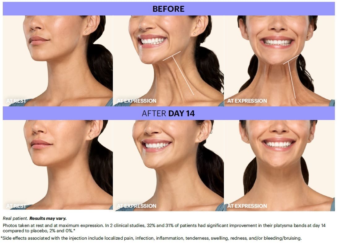 Botox for Platsymal Bands