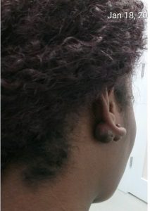 keloid before